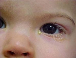 Trẻ sơ sinh bị đau mắt là một vấn đề khiến nhiều bà mẹ lo lắng