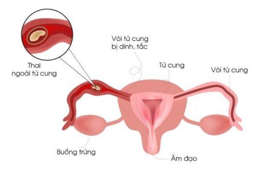 Việc sử dụng que thử thai dựa trên nồng độ hormone HCG có trong nước tiểu, không phụ thuộc vào vị trí của phôi thai trong tử cung
